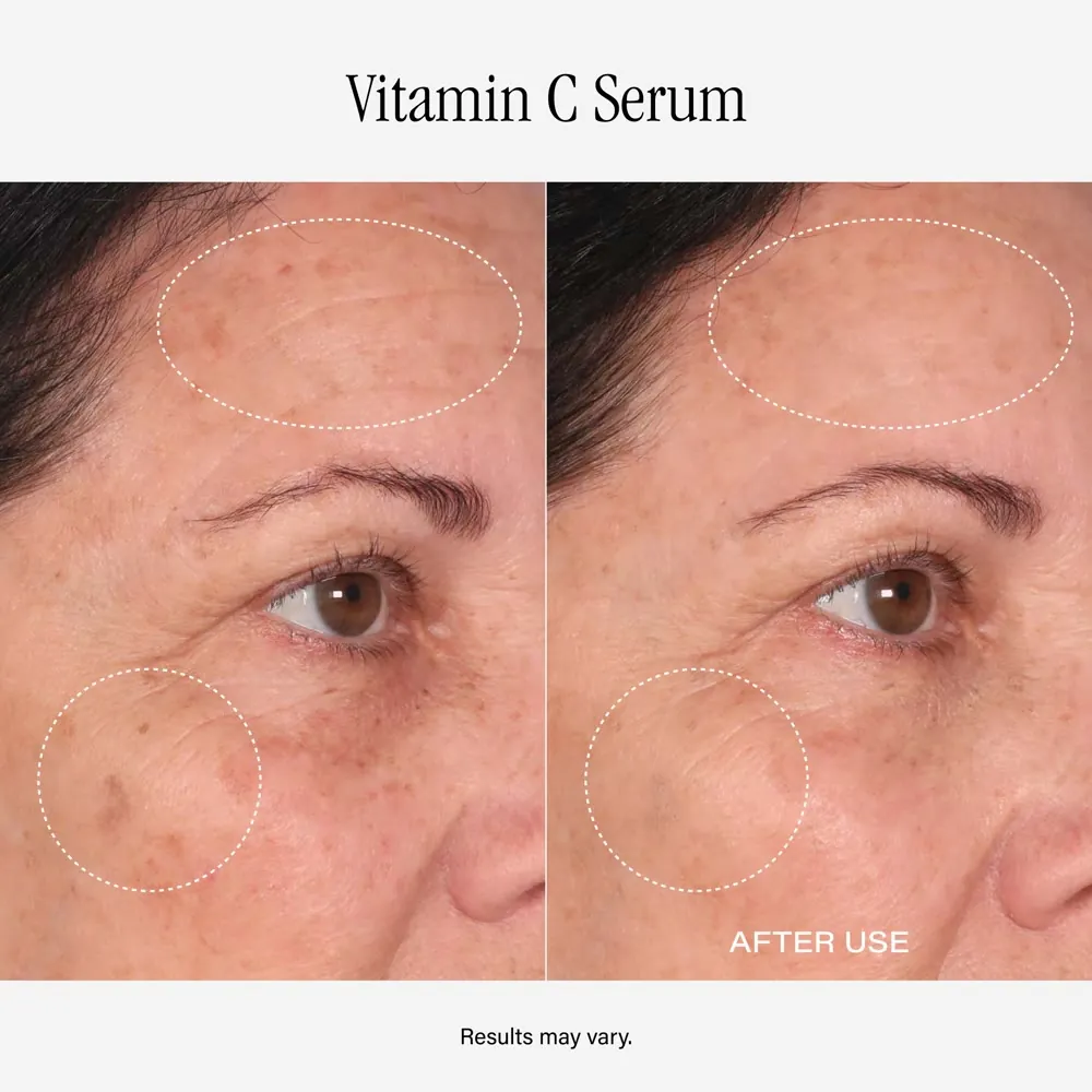 Before and after Vitamin C Serum, result 3